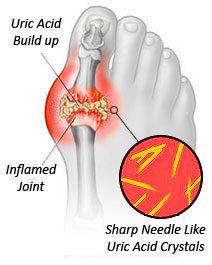 Gout - Symptoms and Treatment